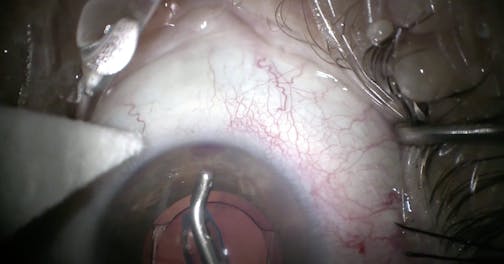 Do You Want to See Some Blanching?