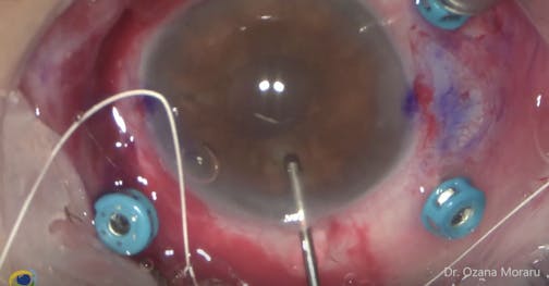 Fluorovitrectomy for Removal of a Dislocated MIOL