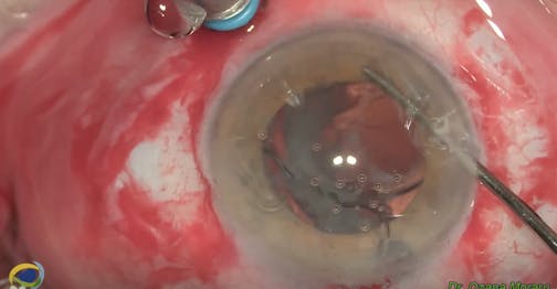 Rescue of Dislocated IOL-Bag-CTR Complex