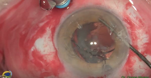 Rescue of Dislocated IOL-Bag-CTR Complex thumbnail