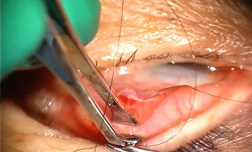 Internal Approach to Ptosis Surgery