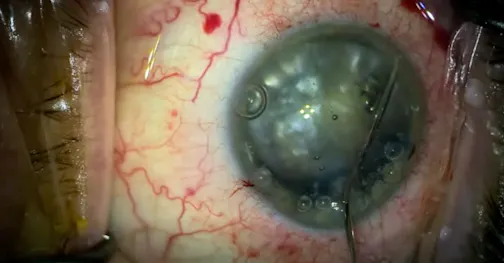 White Cataract After Intravitreal Injections