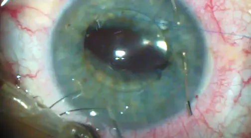 Iris-Sutured IOL