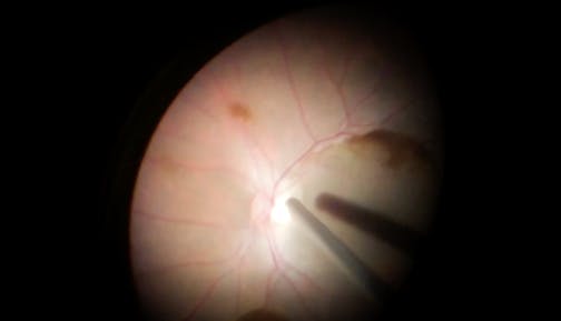 Sub-ILM Hemorrhage After Valsalva Retinopathy