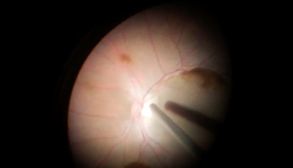 Sub-ILM Hemorrhage After Valsalva Retinopathy thumbnail