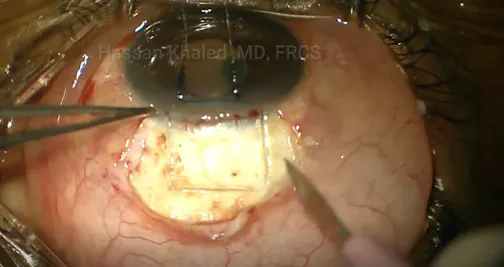 Deep Sclerectomy