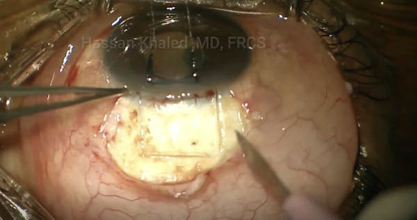 Deep Sclerectomy thumbnail