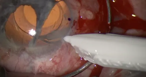 Aniridic IOL Implantation Using Hoffman Scleral Pocket