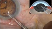 Cataract Evolution