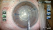 Capsulotomy