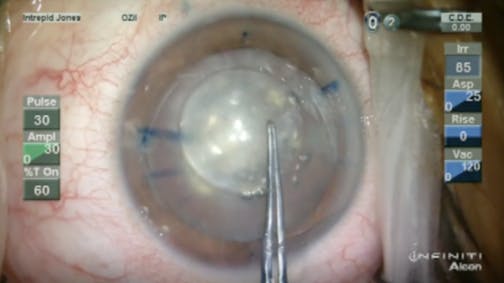 Capsulotomy