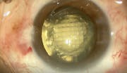 Femtosecond Laser