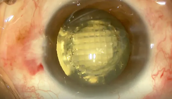 Femtosecond Laser thumbnail