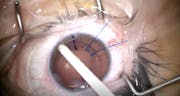 Loose Lens Surgery