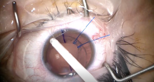 Loose Lens Surgery thumbnail