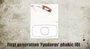 Radial Keratotomy