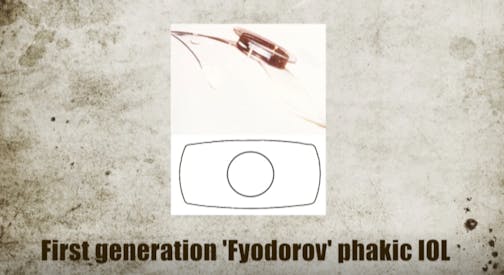 Radial Keratotomy