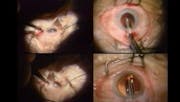 Intraocular Lens Design: An Evolution