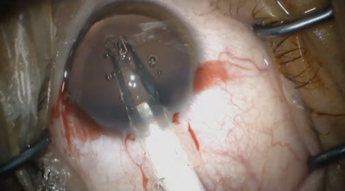 High Myopia Correction