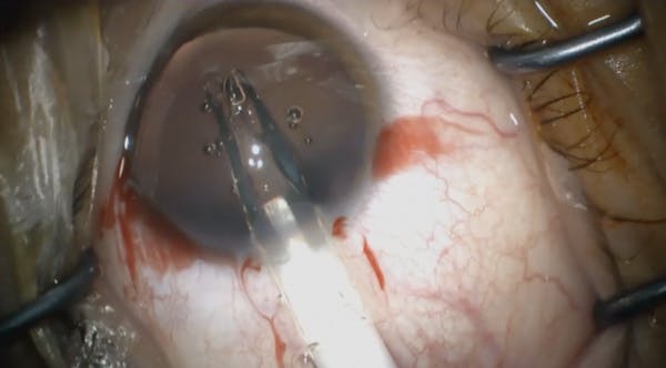 High Myopia Correction thumbnail