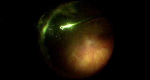Hypersonic Vitrectomy For Removing Retained Lens Material