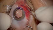 Traumatic Cataract Extraction and IOL Implantation With the In-and-Out Technique