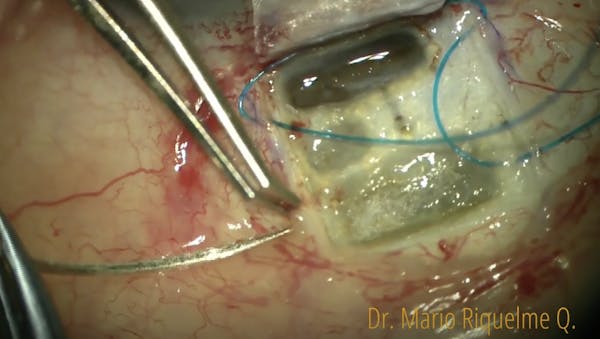 CO2 Laser-Assisted Sclerectomy Surgery With Prolene Spacer thumbnail