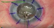 Corneal Transplant With Planned Extracapsular Cataract Extraction, Pupilloplasty, and IOL Implantation