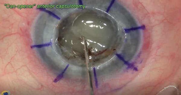Corneal Transplant With Planned Extracapsular Cataract Extraction, Pupilloplasty, and IOL Implantation thumbnail