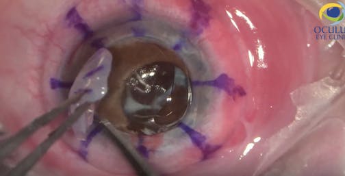 Penetrating Keratoplasty, IOL Exchange, Pupilloplasty, and Anterior Vitrectomy