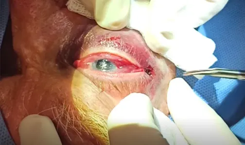 Orbital Compartment Syndrome After Peribulbar Anesthesia