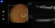 Viscodissection and iOCT for Amniotic Membrane Graft in Macular Hole Surgery