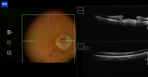 Viscodissection and iOCT for Amniotic Membrane Graft in Macular Hole Surgery