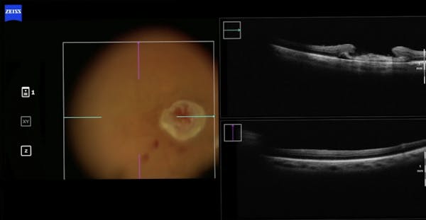 Viscodissection and iOCT for Amniotic Membrane Graft in Macular Hole Surgery thumbnail