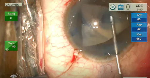 Phacoemulsification With Iris Hooks in a Mature Cataract With Iris Coloboma