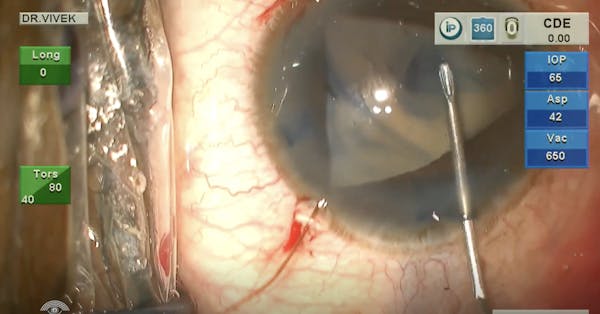 Phacoemulsification With Iris Hooks in a Mature Cataract With Iris Coloboma thumbnail