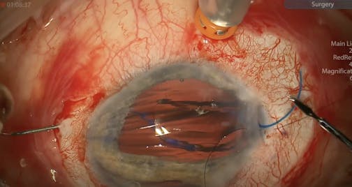 Scleral-Fixated IOL, Pars Plana Vitrectomy, Iridodialysis Repair, Pupilloplasty, and Xen Gel Stent