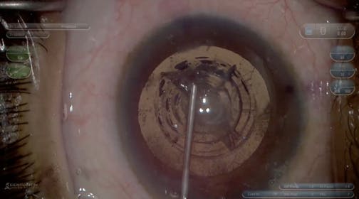 Femtosecond Bridge: Managing the Incomplete Capsulotomy