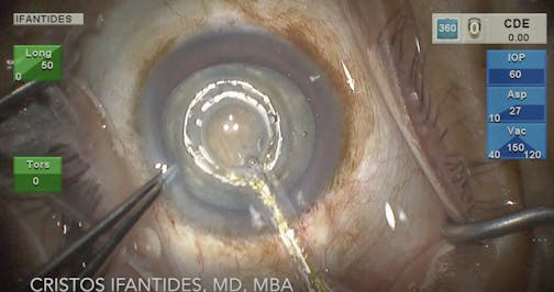 Zepto Capsulotomy Technique for Deep Anterior Chambers