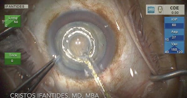 Zepto Capsulotomy Technique for Deep Anterior Chambers thumbnail