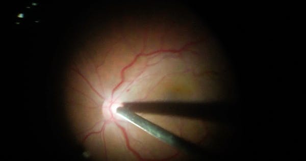 Vitrectomy for Taut Epiretinal Membrane and Macular Pucker thumbnail