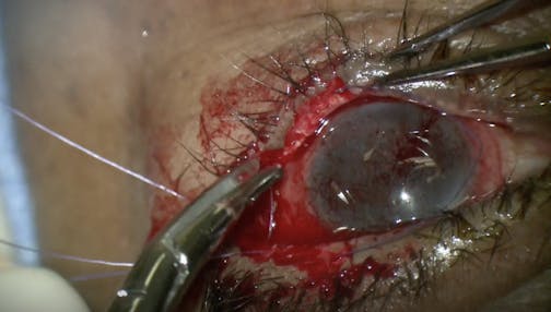 Single Suture Permanent Tarsorrhaphy