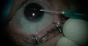 Suprachoroidal Injection With Custom Needle