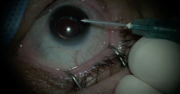 Suprachoroidal Injection With Custom Needle thumbnail
