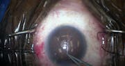 KDB Glide: Excisional Goniotomy