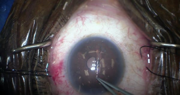 KDB Glide: Excisional Goniotomy thumbnail