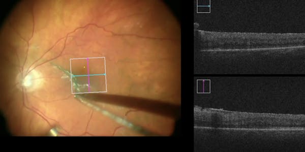 Schisis of Retinal Nerve Fiber Layer and ILM Dehiscence thumbnail