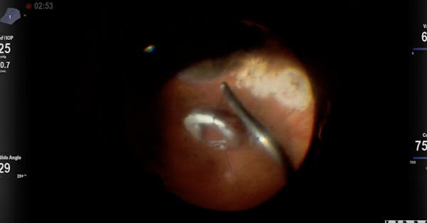 Posteriorly Dislocated IOL Exchange for Anterior Chamber IOL thumbnail