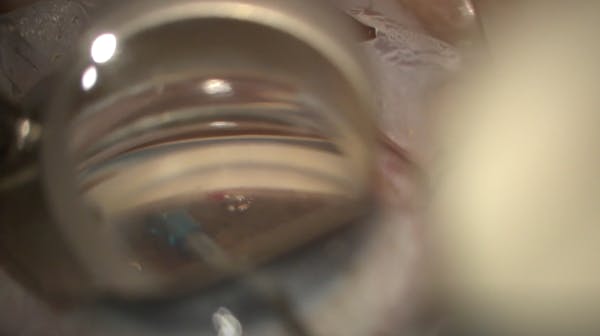 Streamline Goniotomy thumbnail