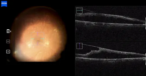 Phacovitrectomy and Membranectomy